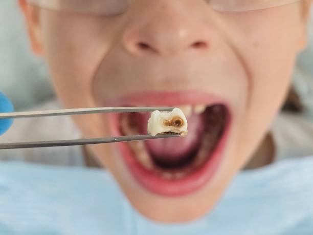 Best Dental Abscess Treatment in Magalia, CA